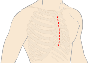 従来の正中切開