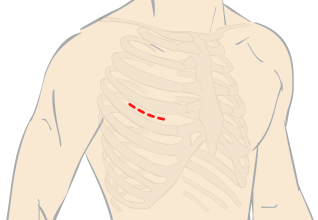 小切開心臓手術(MICS)