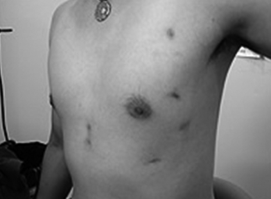 内視鏡下冠動脈バイパス術（オフポンプ）