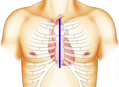 大動脈弁形成術（自己心膜を使用）