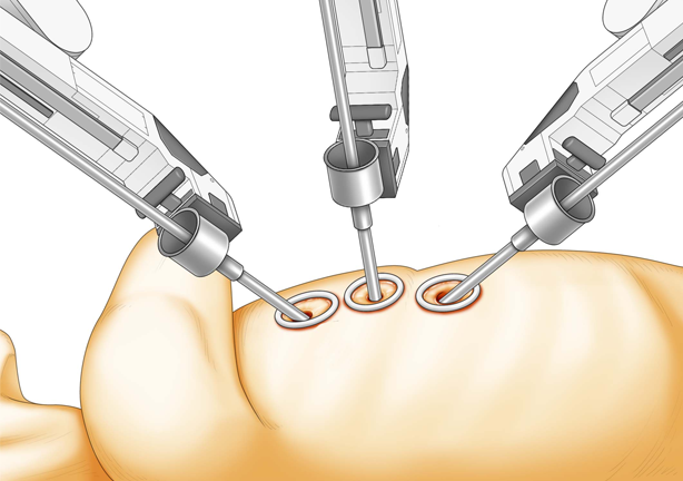 4つの “キーホール（鍵穴）”で術野が広く、ミリ単位のオペを実践