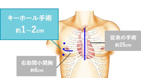 4つの “キーホール（鍵穴）”で術野が広く、ミリ単位のオペを実践